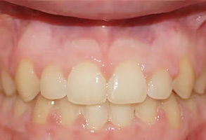 The image displays a close-up view of a person s teeth with a noticeable smile showing multiple teeth, some of which appear to be yellowed or discolored, against a background that seems to be a plain, neutral color.