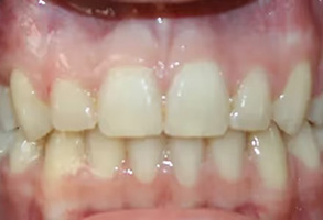 The image displays a close-up view of a person s teeth with some discoloration, particularly on the upper front teeth, which appear to be yellowed.