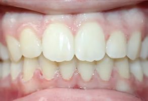 The image displays a close-up view of a person s teeth with a focus on a set of front teeth, showcasing a bright smile with white fillings and a pink tongue visible at the bottom of the frame.