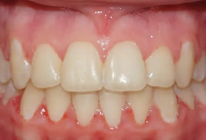 The image shows a close-up view of a person s teeth with visible staining and discoloration, particularly noticeable on the front teeth, which appear yellowish.