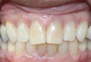 The image shows a close-up view of an individual s mouth with yellowed teeth and gums, which may indicate poor oral hygiene or advanced age.