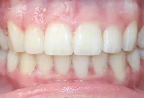 The image shows a close-up of a person s teeth with an emphasis on their yellowing and stained appearance, suggesting a need for dental care or whitening treatment.