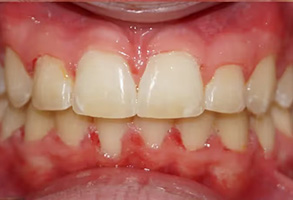 An extreme close-up of a decayed human teeth with stained gums, showcasing severe dental neglect.