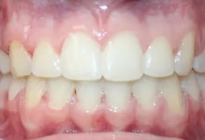 The image shows a close-up view of a person s mouth with teeth, including an upper and lower set, and gums.