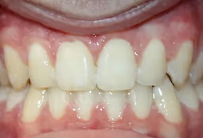 The image shows a person's teeth with a focus on a set of yellowed front teeth.
