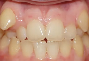 The image shows a close-up view of a mouth with multiple teeth showing signs of decay and discoloration, including yellow stains and areas of missing enamel.