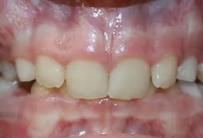 The image shows a close-up of a person s teeth with visible staining and decay, indicating dental health issues.