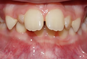 The image shows a close-up view of a person s mouth with multiple teeth missing, revealing a gumline that appears inflamed and red, set against a background that is out of focus.