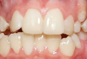 The image displays a close-up view of a person s teeth with a focus on orthodontic work, showing an upper denture in place with visible braces.