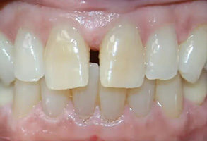 The image shows a close-up view of a person s mouth with visible yellowing and staining on the teeth, some missing teeth, and a partial denture in place.