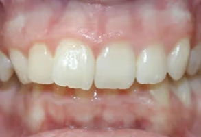 The image shows a close-up view of a person s teeth with a partial denture on the upper right side, displaying a smile with visible fillings and teeth whitening.
