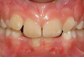 The image shows a close-up view of a mouth with a set of teeth that are yellowed and discolored, indicating possible dental issues or neglect.
