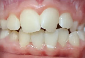 The image shows a close-up view of an open mouth with teeth, including a prominent front tooth with a large gap between the upper and lower incisors.
