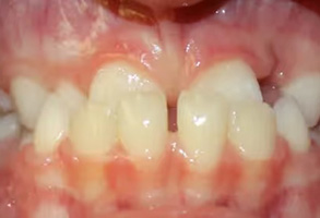The image shows a close-up view of a person s mouth with visible teeth, including a prominent front tooth, and gums with signs of inflammation, possibly indicating dental issues such as gingivitis or an infection.